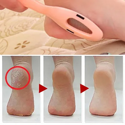 Foot File Hard Dead Skin Callus Remover Rasp Scraper Dead Rough Skin Scrubber • £2.99