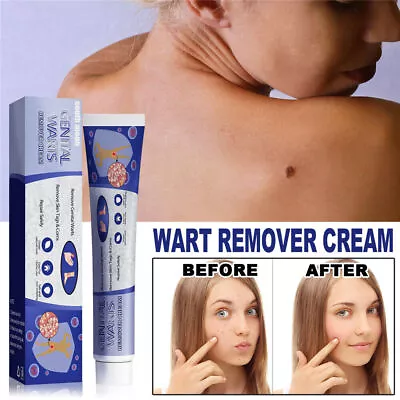 Wart Remover Cream Repair Safely Remove Feet Facial Genital Wart Tags And Corns • £6.89