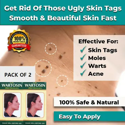 2x New Skin Tag Remover Cream Safe Fast Wart Removal Mole Acne Pimple Patch Spot • £14.40
