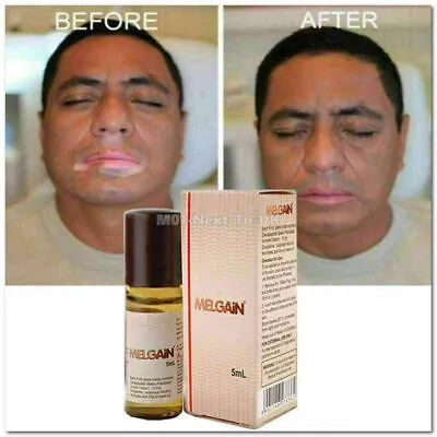 2 X  Melgain Lotion For Vitiligo White Spots Patches Re Pigmentation 5ml  BEST  • $42.50