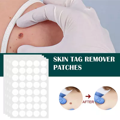 120pcs Skin Tag Remover Patch Wart Treatment Stickers Quick Absorb Plaster • £2.99