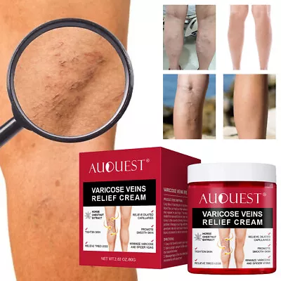 Varicose Veins Relief Cream Vasculitis Phlebitis Pain Ointment 80g • £6.97