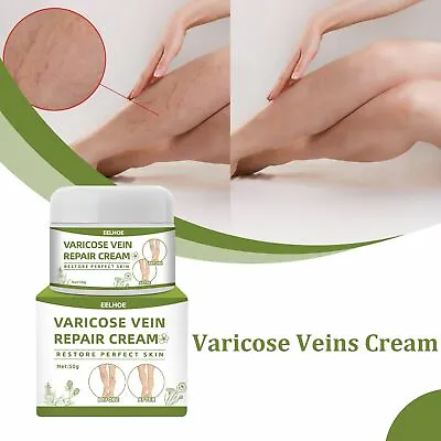 Treatment Legs Varicose Veins Cream Vein Care Fading Cream Herbal Ointment • £4.95