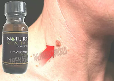 Homeopathic Organic Skin Tag Wart Mole Remover Quita Verrugas Removedor Verruga  • $13.99