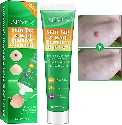 Skin Tag & Wart Remover Removal Cream Ointment ADVANCED Skin Tag Mole Treatment • £14.99