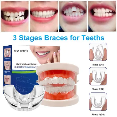 Dental Orthodontic 3 Stage Teeth Corrector Braces Tooth Retainer Straighten Tool • £4.83