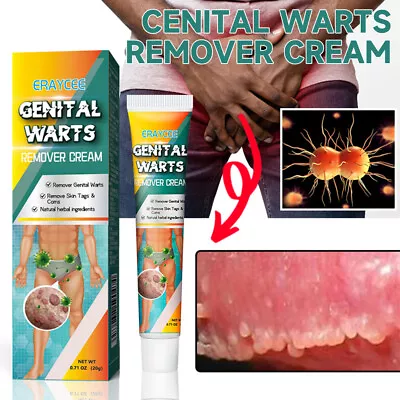 UK Genital Herpes Wart Remover Ointment Skin Tag Mole Acuminatum Treatment Cream • £3.11