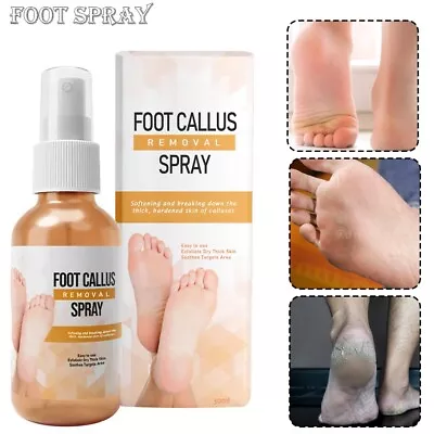 30ml Foot Callus Removal Spray Peeling Natural Essence Exfoliating Dead Skin • £4.79