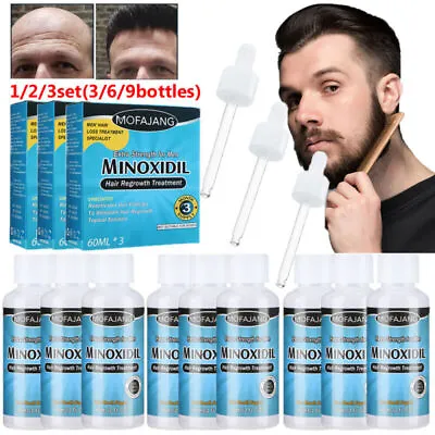 9X Hair Regrowth Extra Strength Topical Hair Loss Treatment For Men Solution UK • £21.95
