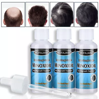 3PC 3 Months Extras Strength Mens Regrowth Treatment Regain Hair Growth Solution • £11.95