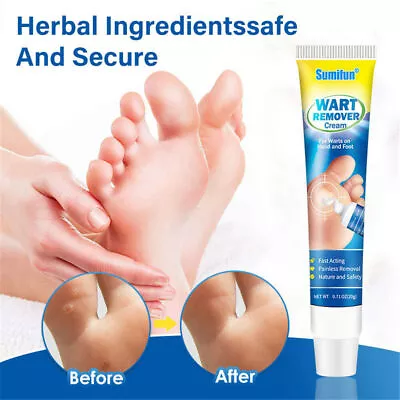 Wart Removal Cream Chicken Eye Cream Wart Flat Corn Plaster Treatment Skin Tags • £6.74