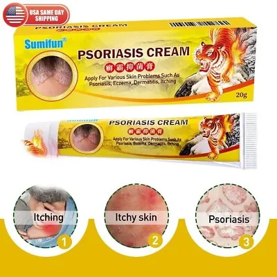 Crema Para Dermatitis Eczema Psoriasis Para Comezon Picazon Ronchas En La Piel • $19.90