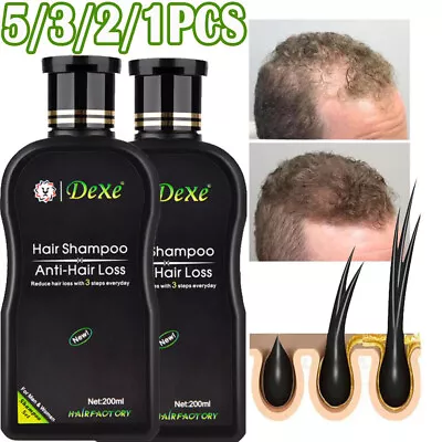 5/1PC DEXE Hair Growth Shampoo For Women Men Anti Hair Loss Treatment Thickening • £22.95