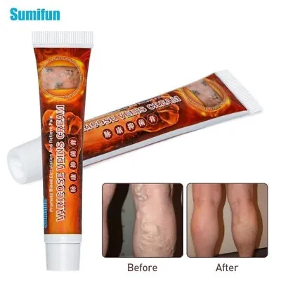 New Original Vasculitis Blood Circulation Varicose Veins Treatment New Cream 20g • £4.68