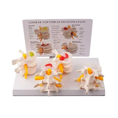 New Sick Human Lumbar Vertebrae Degenerative Disc Disease Model Anatomical • $36.88