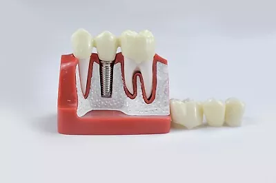 Dental Orthodontics Typodont Implant Analysis Crown Bridge Demonstration Model • $33.15