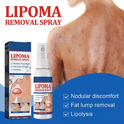 £6.99 • Buy 50ml Lipoma Removal Spray Herbal Exfoliating Skin Anti- Swelling Pain Relief~