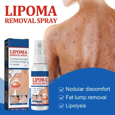 £6.99 • Buy 50ml Lipoma Removal Spray Herbal Exfoliating Skin Anti- Swelling Pain Relief~