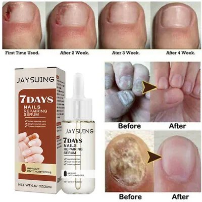 Anti Fungal Nail Treatment Finger Toe Care Fungus Fungi Liquid Repair Pen Remove • $9.28