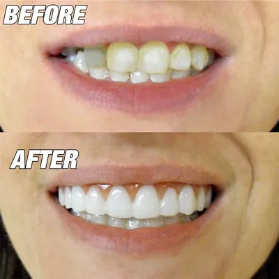 Snap On Bottom /Upper Lower False Teeth Dental Veneers Dentures Fake Tooth Smile • $9.49