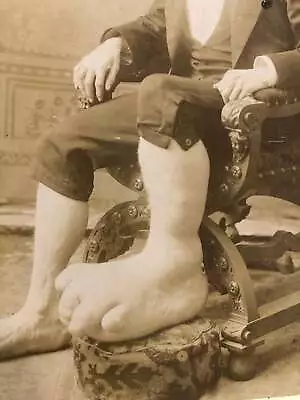 Rare Medical & Anatomical Curiosity   Ohio Big Foot Boy  Antique Photo Oddities • $1200