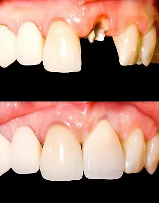 Temporary Tooth Kit Temp Repair Replace Missing DIY Safe Easy Video Link Teeth • $7.95