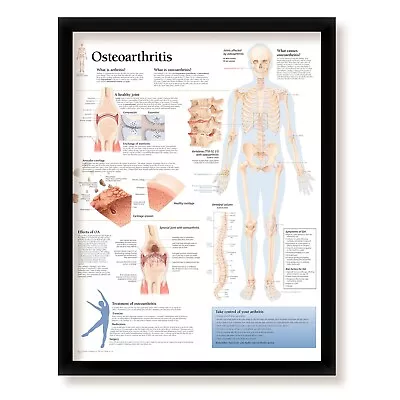 Framed Medical Poster Osteoarthritis  22x28 Wall Diagram Educational • $65.99