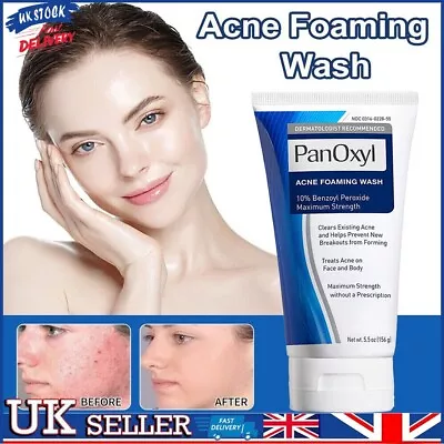 Acne Foaming Wash Face & Body 10% Active Ingredient 156g New UK • £7.31