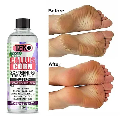 CALLUS REMOVER Hard Dead Skin CORN Treatment Quick Fix Pedicure FOOT GEL • £3.39