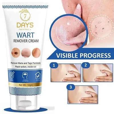 7 Days Genital Wart Removal Cream For Men & Women 50g • £16.49
