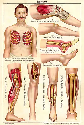 Vtg French Anatomical Bone Fracture Trauma Chart #2 NEW Fine Art Print Legs  • $6.99