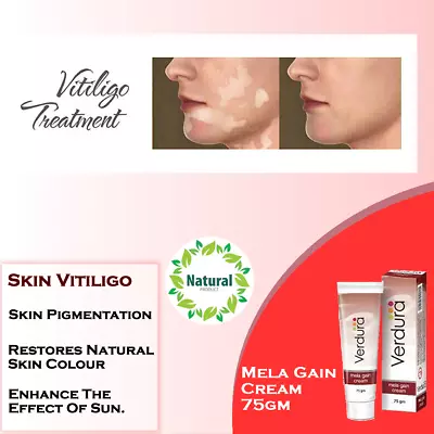 Melagain Cream Treatment For Vitiligo 75g For Sensitive Skin & Uneven Skin Tone • $29.99