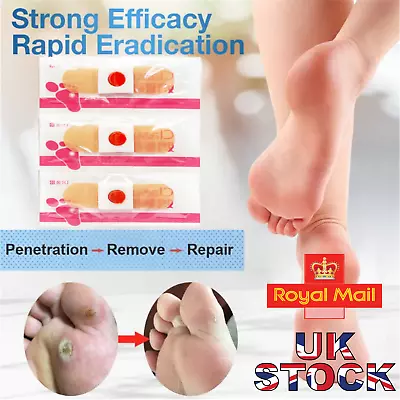 NEW STYLE Foot Corn Remover Pads Plantar Wart Thorn Plaster Patch Callus Removal • £3.99