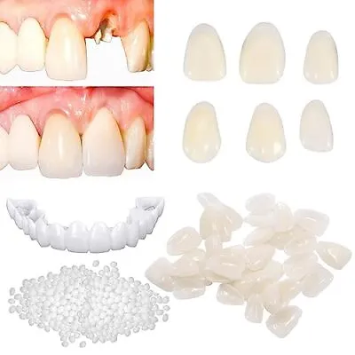 Temporary Tooth Repair Kit For Filling The Missing Broken Tooth And Gaps-Mold • $21.91