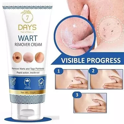 Genital Wart Removal Treatment Cream. Discreet Free Packaging Included 50g. • £18.19