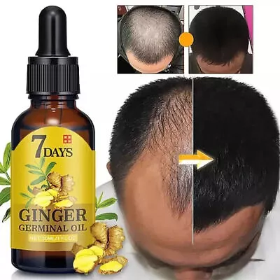 Natural Hair Loss Treatment Ginger Germinal Hair Growth Serum For Men & Women. • $28.95