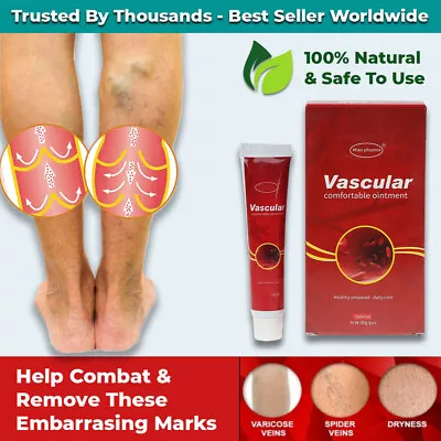 Varicose Veins Treatment Cream Vasculitis Phlebitis Spider Veins Stretch Marks • £11.95