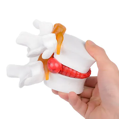 1:1 Human Anatomy Skeleton Spine Lumbar Disc Herniation Teaching Model US Stock • $22.79