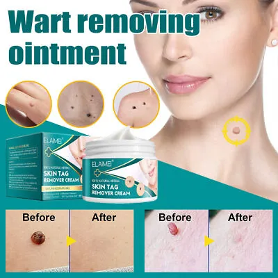 Skin Tag Removal Treatment Cream Face Care Mole Wart Remover Cream Ointment UK • £10.29