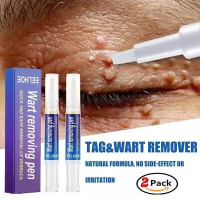 2 Pack 12Hours Wart Remover Pen Skin Tag Mole Remover Eliminate Foot Corn Warts • £7.95