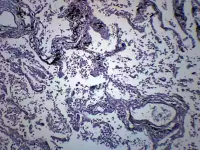 Pneumonia In Human Lungs - Prepared Slide - 75x25mm - Eisco Labs • $6.99