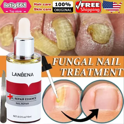 Fungal Nail Repair Treatment Essence Serum Anti Fungus Removal + Nail File Hand • $8.95