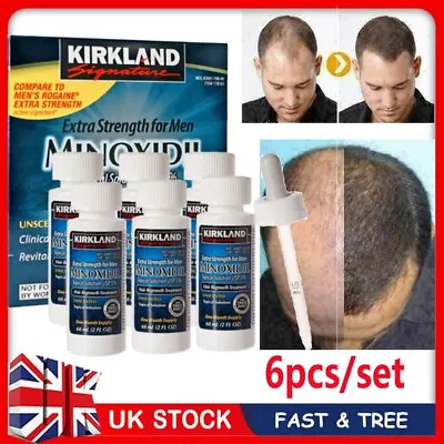 1/6X 5% Extra Strength Men Regrowth Regain Treatment Solution 3/6 Month Supply • £8.40