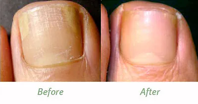 NEW Fungal Treatment Lotion Kills 99.9% Skin & Nail Fungus & Toes Evterpa  50ml • £7.07