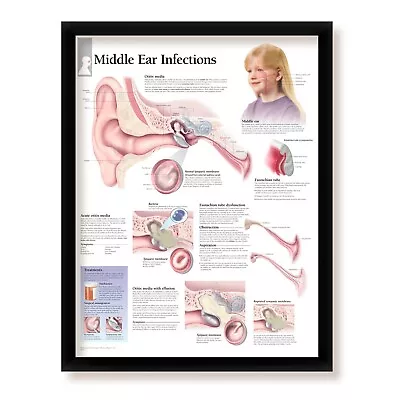 Middle Ear Infections Framed Medical Informational Poster 22x28 Wall Diagram • $65.99