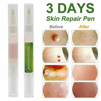 Skin Tag Removal Treatment Cream Face Care Mole Corn Wart Remover Natural Pen • £4.04