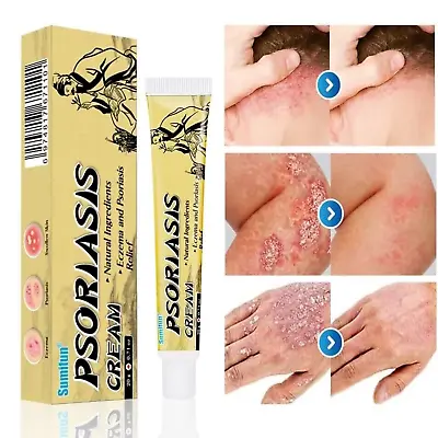 Crema Para Dermatitis Eczema Psoriasis Para Comezon Picazon Ronchas En La Piel • $19.95