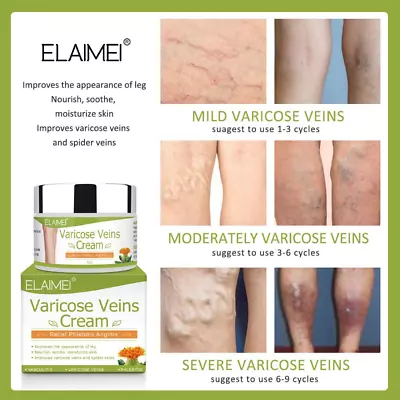 Varicose Veins Cream Relief Phlebitis Angiitis Inflammation Blood Vein Veins • $16.95