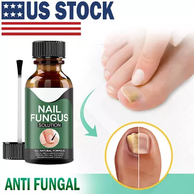 Anti Fungal Treatment Extra Strength Toenail Fungus Athletes Foot Fungi Nail #1 • $8.99