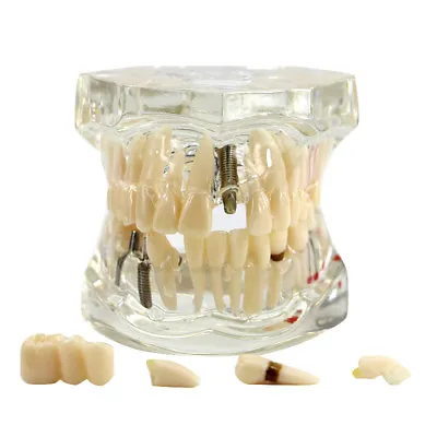 $16.99 • Buy Dental Teeth Model Brackets Study Implant Pathological Disease Restoration Teach
